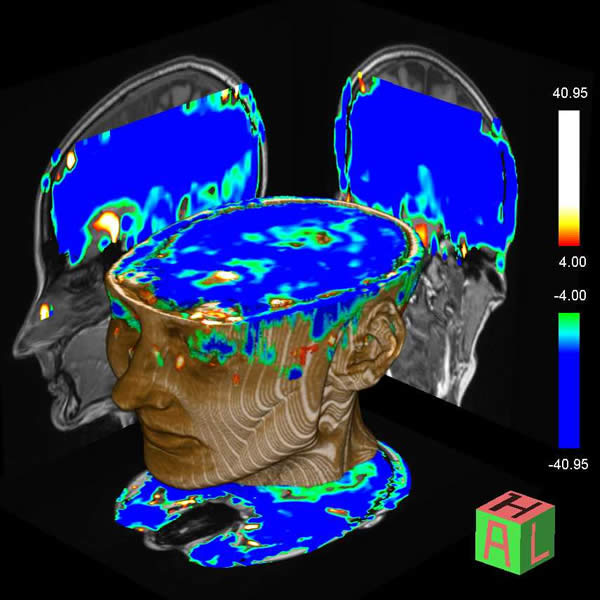 An MRI scan showing blood flow in the brain