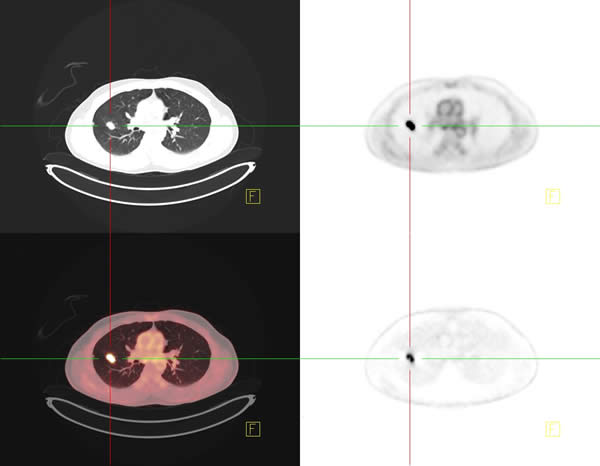 A CT-positron emission tomography (PET/CT) scanner can identify the spread of cancer using tracers created by a cyclotron and radiochemistry laboratories on-site.