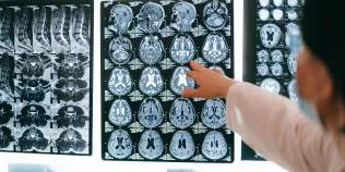 doctor pointing to MRI brain scans