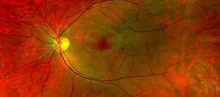 scan of the back of the eye showing small blood vessels