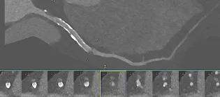 Ultra-high-resolution photon-counting CT imaging of a coronary artery in a patient with coronary artery disease and a previous stent.
