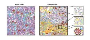 Spatial transcriptomics highlights influx of immune cells (orange) and scar-producing fibroblasts (yellow) in the injured kidney. 