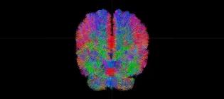 Edinburgh Imaging - brain scan
