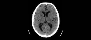 A CT scan of the brain, commonly used for patients with stroke