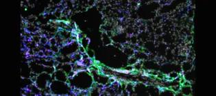 CCR2+ monocytes are the source of scar associated macrophages in the injured kidney. White:Dapi Green:COL1a1 Red:CCR2+ TdT+ myeloid cells, Blue:IBA1.