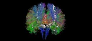 Image of the brain’s white matter tracks and white matter hyperintensities (white structures) in an older age volunteer created from diffusion MRI