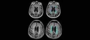 Row Fogo Centre for Research into Ageing and the Brain