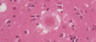 A collection of abnormal protein in the brain of a patient with variant CJD.