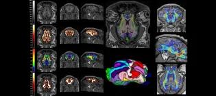 Examples of human brain MRI measurements applied to sheep models of health and disease, including the grey mater (thinking) and white matter (wiring).