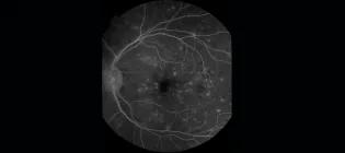 An example of blood-retina barrier breakdown in cerebral malaria - an acute severe type of cerebral small vessel disease