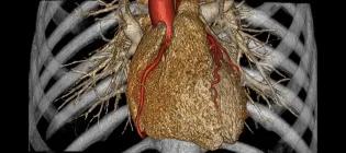 3D CT reconstruction of the heart and coronary arteries, enabling non-invasive imaging detection of cardiovascular disease.