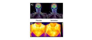 A) PET/MRI and B) thermal images to quantify brown adipose tissue activity during mild cold exposure, and the effect of the SSRI sertraline.