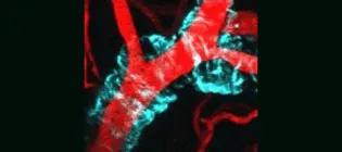 A blood vessel with amyloid-beta deposition in the wall.