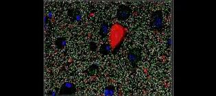 High-resolution image of synapses (green and grey), cells (blue) and a tau pathology (red) in Alzheimer's disease brain tissue.