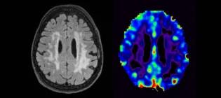 MRI scan showing small vessel disease, a common cause of cognitive impairment.