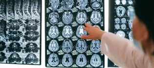 doctor pointing to MRI brain scans