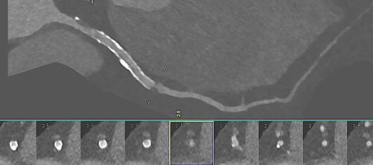 Ultra-high-resolution photon-counting CT imaging of a coronary artery in a patient with coronary artery disease and a previous stent.