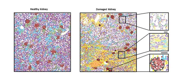 Spatial transcriptomics highlights influx of immune cells (orange) and scar-producing fibroblasts (yellow) in the injured kidney. 