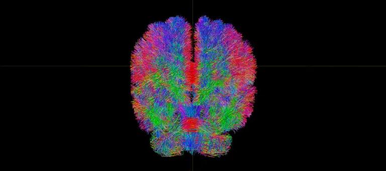 Edinburgh Imaging - brain scan