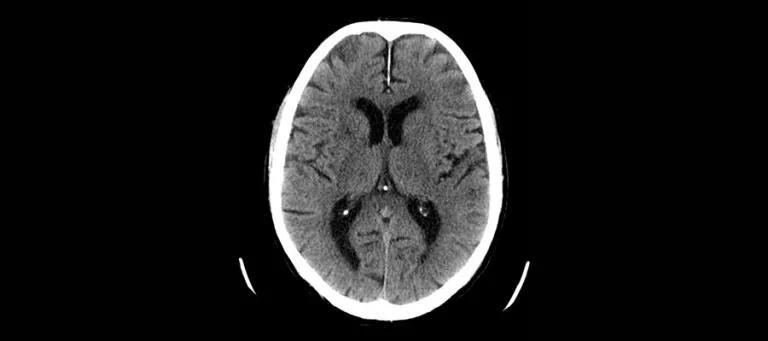A CT scan of the brain, commonly used for patients with stroke