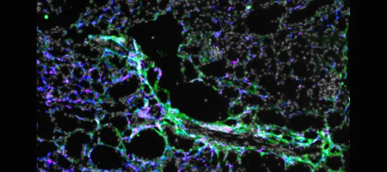 CCR2+ monocytes are the source of scar associated macrophages in the injured kidney. White:Dapi Green:COL1a1 Red:CCR2+ TdT+ myeloid cells, Blue:IBA1.