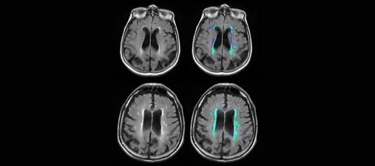Row Fogo Centre for Research into Ageing and the Brain