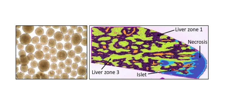 Stem cell-derived islets in culture (left) and after transplantation via the hepatic portal vein into mouse liver (right).