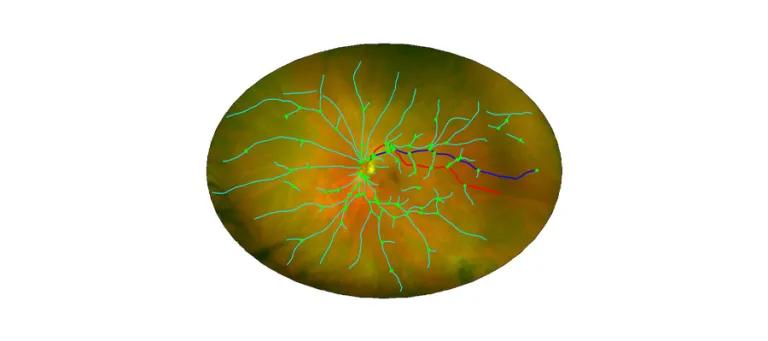 Detecting and analysing retinal vessels reveals subtle changes in microvascular health linked to conditions affecting the brain and body.