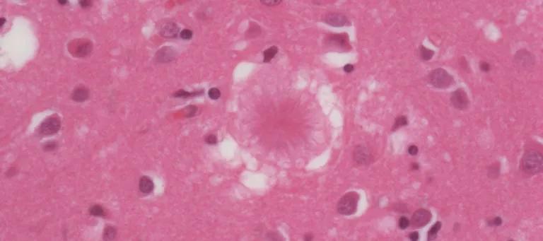 A collection of abnormal protein in the brain of a patient with variant CJD.
