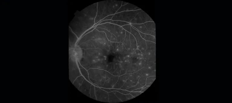 An example of blood-retina barrier breakdown in cerebral malaria - an acute severe type of cerebral small vessel disease
