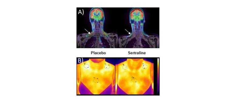 A) PET/MRI and B) thermal images to quantify brown adipose tissue activity during mild cold exposure, and the effect of the SSRI sertraline.