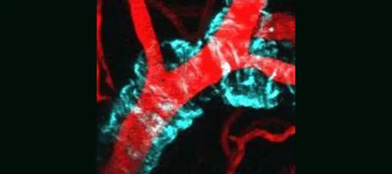 A blood vessel with amyloid-beta deposition in the wall.