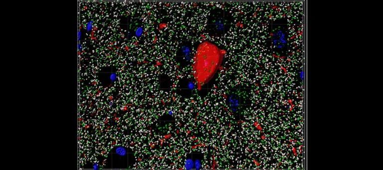 High-resolution image of synapses (green and grey), cells (blue) and a tau pathology (red) in Alzheimer's disease brain tissue.