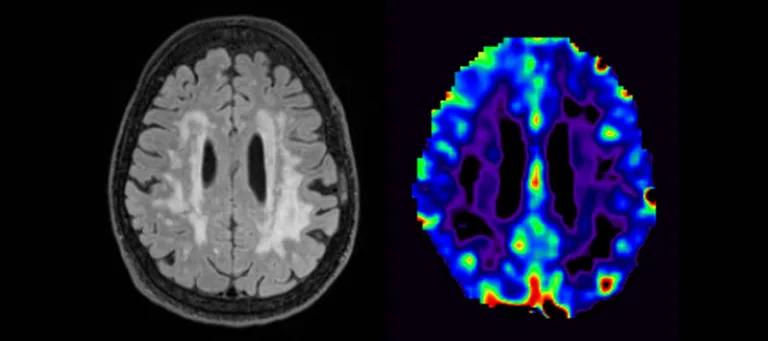 MRI scan showing small vessel disease, a common cause of cognitive impairment.