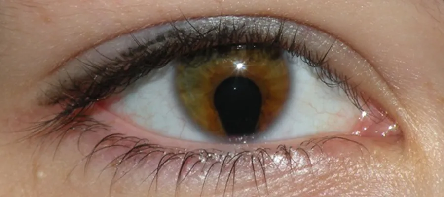 Coloboma of the iris in a 16 year old woman